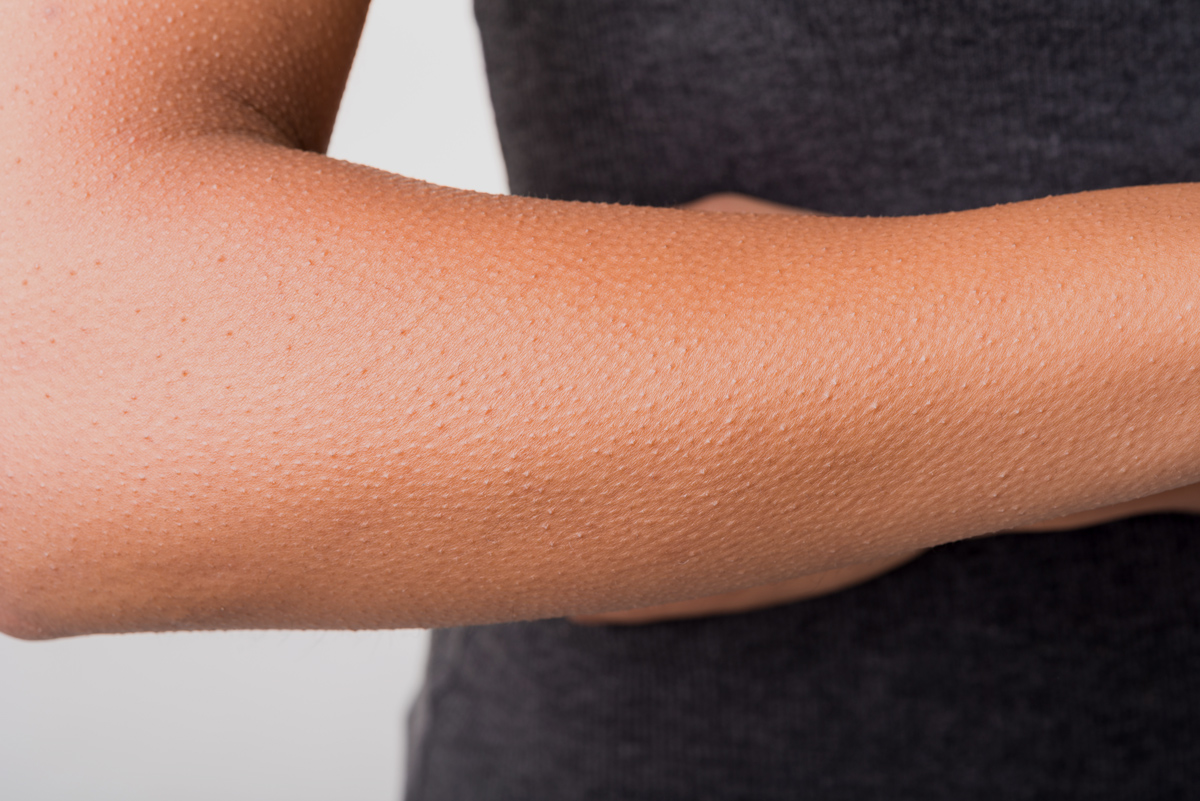 Goose bumps on a human arm
