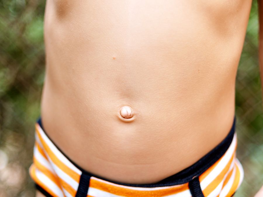 Why Are Some Belly Buttons Outies?