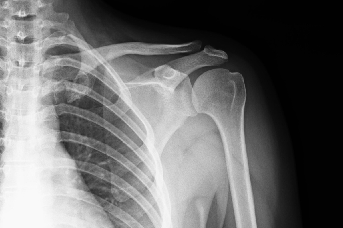 X-ray of top-left torso and shoulder