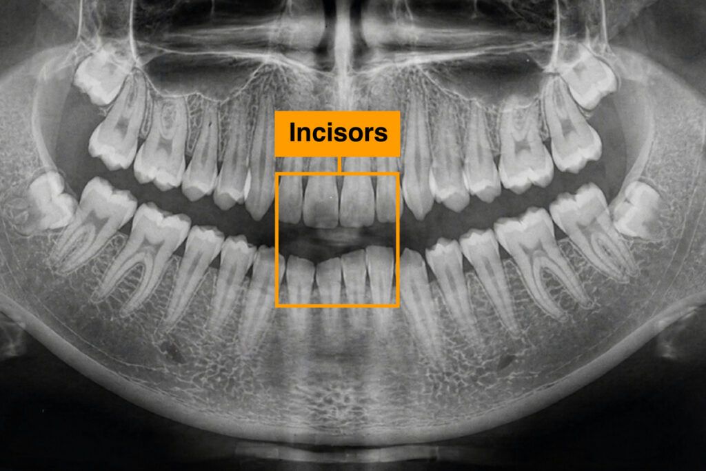 X-ray highlighting incisors