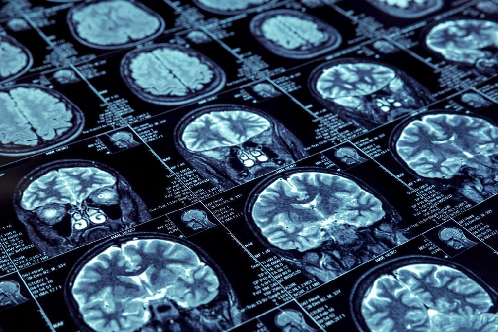 Brain scans