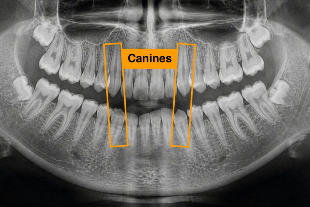 X-ray highlighting canines