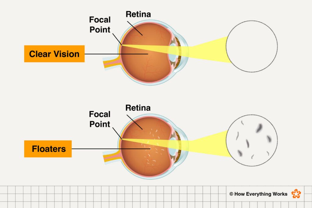 Illustration showing how eye floaters work