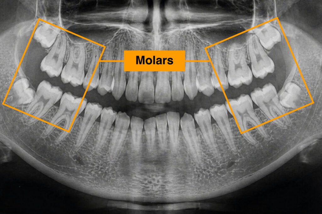X-ray highlighting molars