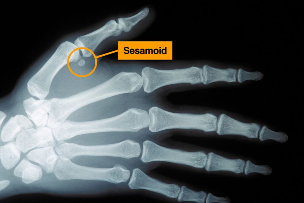 X-ray with Sesamoid pointed out